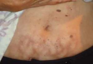 Подкожные кровоизлияния, вздутия и коричневые пятна 