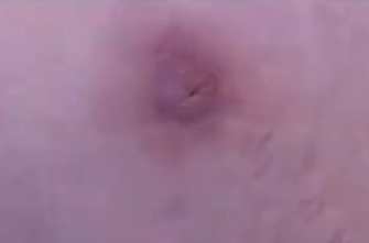 Снимки множественной кожной инфекции у самой Дженнифер за 13 января