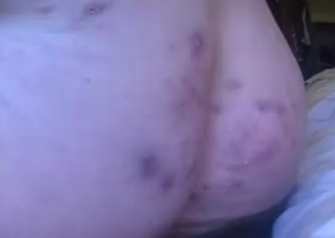 Снимки множественной кожной инфекции у самой Дженнифер за 13 января