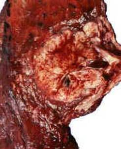 Лёгкие курильщиков с 5-летним стажем.