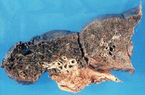 Лёгкие курильщиков с 10-летним стажем.