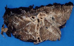 Лёгкие курильщиков с 15-летним стажем.